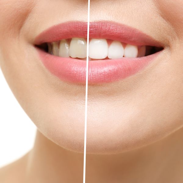 teeth-whitening
